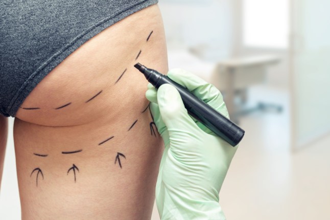 plastic surgeon marking womans body for plastic surgery