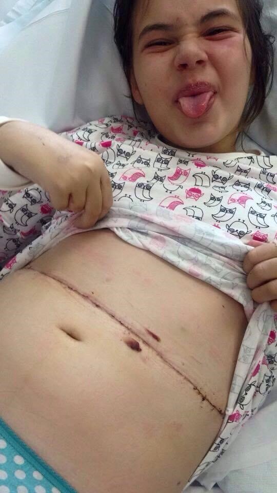 Young Milly lifts her t-shirt showing off her scar and sticks out her tongue