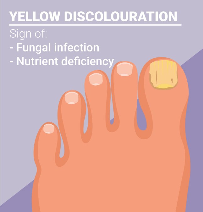 What your toenails say about your health