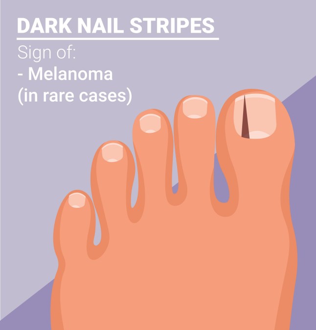 What your toenails say about your health