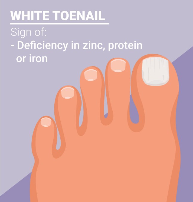 What your toenails say about your health
