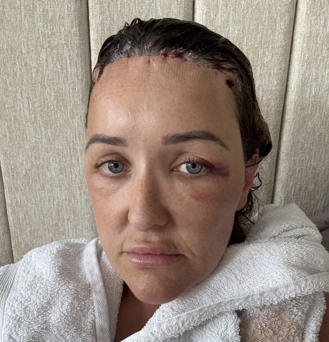 PIC FROM KENNEDY NEWS AND MEDIA (PICTURED: CHLOE WALKER, 34, AFTER HER FOREHEAD REDUCTION SURGERY) A mum felt so self-conscious about her hairline that she would EDIT PHOTOS to 'shrink' her 9cm forehead - before surgery 'changed her life'. Chloe Walker had always been insecure about the size of her forehead and kept it covered with a fringe since she was around 10 years old. The 34-year-old reckons she's gone through thousands of bottles of hairspray over her lifetime as she desperately tried to keep the fringe in place. DISCLAIMER: While Kennedy News and Media uses its best endeavours to establish the copyright and authenticity of all pictures supplied, it accepts no liability for any damage, loss or legal action caused by the use of images supplied and the publication of images is solely at your discretion. SEE KENNEDY NEWS COPY - 0161 697 4266