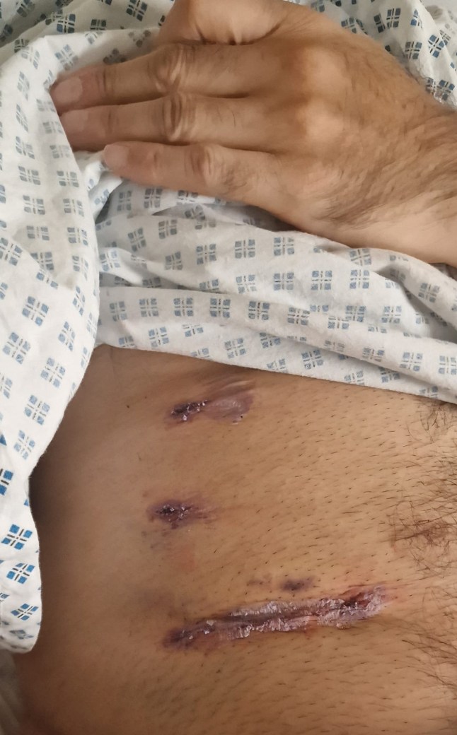 Umesh Patel's scarred stomach after surgery