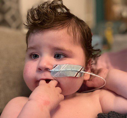A baby with a tube coming from his nose