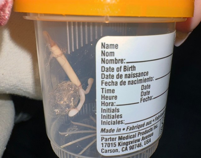 @abbie.nicoleee / CATERS NEWS - (PICTURED Abbie's IUD hairball) -A woman has gone viral after revealing doctors pulled out her IUD, with a giant hairball attached. Abbie Elian from San Diego, California, USA, who shared her story online, admitted that when doctors removed it, they were stunned to find it coated in what they called a hairball. According to the 29-year-old, she'd been suffering through an endless cycle of infections, pain, and fatigue. Multiple UTIs, yeast infections, sharp pelvic cramps, and even kidney stones piled up before nurses finally suggested her IUD might be the culprit. SEE CATERS COPY