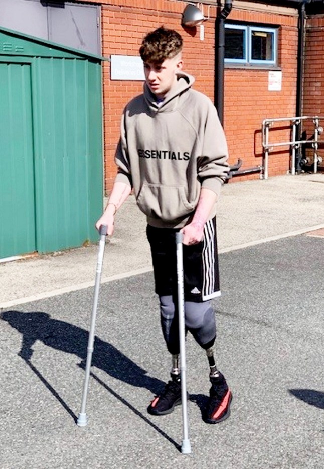 Levi Dewy had to have both of his legs amputated due to sepsis. A "fit and healthy" young man was forced to have both of his legs amputated just days before his 21st birthday - after his flu-like symptoms turned out to be sepsis. Levi Dewy was left in an induced coma with just a 30 per cent chance of survival after being struck down with the life-threatening condition. The previously active 20-year-old, who loved playing football, first fell sick with flu-like symptoms and began taking over-the-counter medications. But mum Lara took him to hospital after "mothers intuition" told her something was wrong when his condition failed to improve. The former JCB welder then went into sceptic shock and suffered multiple organ failure at Royal Derby Hospital. Medics found he was suffering from pneumococcal pneumonia and sepsis and he was transferred to Leicester's Glenfield Hospital for specialist treatment. Doctors told Lara and dad Neil their son would need surgery to amputate both legs below the knee - an operation he had two days before his 21st birthday. When he woke up Levi said he felt lucky to be alive but 'nothing could prepare him for how much his life would change.' Photo released 06/10/2025