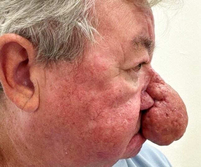 Gerard McAliece' nose before treatment. // A man was left unable to kiss his wife after one of the "worst cases" of nose growth a clinic had ever seen. Gerard McAliece, 68, from Kilmalcolm, had first started noticing changes to his nose six years ago - as it kept "growing and growing." He was suffering from a severe case of Rhinophyma, a condition caused by the proliferation of sebaceous glands in the nose and underlying connective tissue - leading to severe swelling, redness, and lumps. Tissue on Gerard's nose had expanded to such an extent that it was hanging down over his mouth and covering a large part of his face. He had become self-conscious, nervous about his grandchildren being judged for his appearance - and the growth had stopped him from being able to kiss his wife, Carol. Photo released 13/10/2025