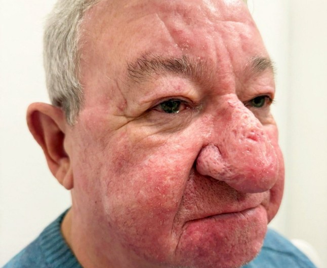 Gerard McAliece' nose after treatment. // A man was left unable to kiss his wife after one of the "worst cases" of nose growth a clinic had ever seen. Gerard McAliece, 68, from Kilmalcolm, had first started noticing changes to his nose six years ago - as it kept "growing and growing." He was suffering from a severe case of Rhinophyma, a condition caused by the proliferation of sebaceous glands in the nose and underlying connective tissue - leading to severe swelling, redness, and lumps. Tissue on Gerard's nose had expanded to such an extent that it was hanging down over his mouth and covering a large part of his face. He had become self-conscious, nervous about his grandchildren being judged for his appearance - and the growth had stopped him from being able to kiss his wife, Carol. Photo released 13/10/2025