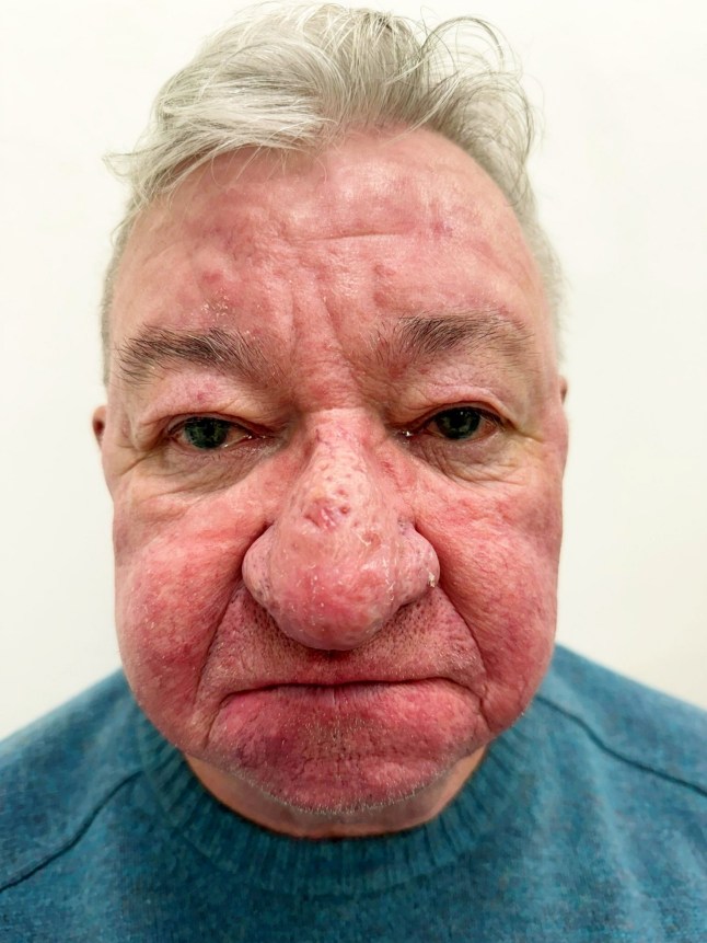 Gerard McAliece' nose after treatment. // A man was left unable to kiss his wife after one of the "worst cases" of nose growth a clinic had ever seen. Gerard McAliece, 68, from Kilmalcolm, had first started noticing changes to his nose six years ago - as it kept "growing and growing." He was suffering from a severe case of Rhinophyma, a condition caused by the proliferation of sebaceous glands in the nose and underlying connective tissue - leading to severe swelling, redness, and lumps. Tissue on Gerard's nose had expanded to such an extent that it was hanging down over his mouth and covering a large part of his face. He had become self-conscious, nervous about his grandchildren being judged for his appearance - and the growth had stopped him from being able to kiss his wife, Carol. Photo released 13/10/2025