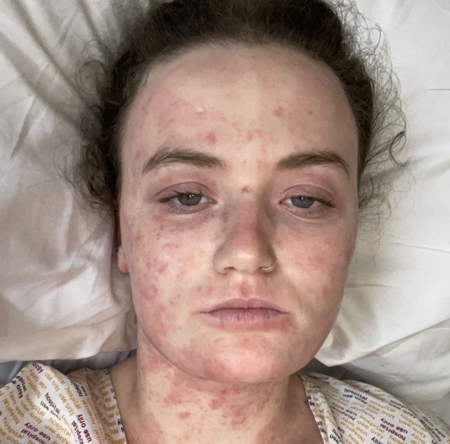 Pic from Kennedy News & Media (Pictured: SKYE OWEN, THEN 23, IN HOSPITAL WHEN SHE CLAIMS SHE HAD HOSPITAL AND HER IMMUNE SYSTEM WAS WEAK.) A super-fit outdoor instructor claims doctors dismissed her for being 'dramatic' over back pain - that turned out to be killer sepsis. Skye Owen, from Newquay, Cornwall, first began to experience hip pain after a weekend of hiking, surfing and climbing in September 2024. When the pain began to travel up her lower back days later, she booked a GP appointment and said she was told her hip and back pain was sciatica and sent her home to rest. DISCLAIMER: While Kennedy News and Media uses its best endeavours to establish the copyright and authenticity of all pictures supplied, it accepts no liability for any damage, loss or legal action caused by the use of images supplied and the publication of images is solely at your discretion. SEE KENNEDY NEWS COPY - 0161 697 4266