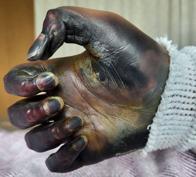 Pic from Kennedy News & Media (Pictured: 41-YEAR-OLD JANE HALEY'S HANDS AND FEET BEFORE THEY WERE AMPUTATED.) A sports-mad woman was left a quadruple amputee after swollen glands from 'an infection' turned out to be deadly septic toxic shock syndrome. Jane Haley, from Alberta in Canada, suffered from strep throat in June 2025 but after taking a course of antibiotics said she was back to her normal self. When she began to develop a pain in her jaw, cheek and the left side of her neck in August, she assumed it was an infection and called a medical advice health line. DISCLAIMER: While Kennedy News and Media uses its best endeavours to establish the copyright and authenticity of all pictures supplied, it accepts no liability for any damage, loss or legal action caused by the use of images supplied and the publication of images is solely at your discretion. SEE KENNEDY NEWS COPY - 0161 697 4266