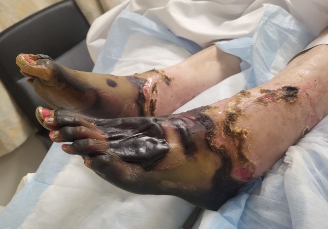 Pic from Kennedy News & Media (Pictured: 41-YEAR-OLD JANE HALEY'S HANDS AND FEET BEFORE THEY WERE AMPUTATED.) A sports-mad woman was left a quadruple amputee after swollen glands from 'an infection' turned out to be deadly septic toxic shock syndrome. Jane Haley, from Alberta in Canada, suffered from strep throat in June 2025 but after taking a course of antibiotics said she was back to her normal self. When she began to develop a pain in her jaw, cheek and the left side of her neck in August, she assumed it was an infection and called a medical advice health line. DISCLAIMER: While Kennedy News and Media uses its best endeavours to establish the copyright and authenticity of all pictures supplied, it accepts no liability for any damage, loss or legal action caused by the use of images supplied and the publication of images is solely at your discretion. SEE KENNEDY NEWS COPY - 0161 697 4266
