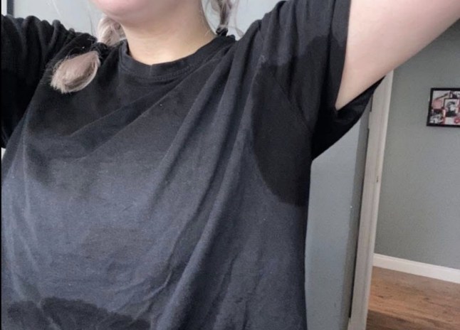 PIC FROM Kennedy News and Media (PIC SHOWS: DARCIE HAMILTON'S SWEAT PATCHES ON HER CLOTHES DUE TO HER HYPERHIDROSIS) A woman with 'one of the worst cases' of sweating doctors have ever seen says the rare condition left her perspiring THREE LITRES of sweat a day. Darcie Hamilton, who lives near Ayr, Scotland, noticed she was sweating more than her peers at 10 years old during primary school. But as she grew older, Darcie's issue worsened, forcing her to take desperate measures to hide her problem from classmates. DISCLAIMER: While Kennedy News and Media uses its best endeavours to establish the copyright and authenticity of all pictures supplied, it accepts no liability for any damage, loss or legal action caused by the use of images supplied and the publication of images is solely at your discretion. SEE KENNEDY NEWS COPY - 0161 697 4266