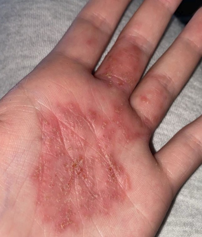 PIC FROM Kennedy News and Media (PIC SHOWS: DARCIE HAMILTON, 22, WAS LEFT WITH SORES ON HER HANDS DUE TO EXCESSIVE SWEATING) A woman with 'one of the worst cases' of sweating doctors have ever seen says the rare condition left her perspiring THREE LITRES of sweat a day. Darcie Hamilton, who lives near Ayr, Scotland, noticed she was sweating more than her peers at 10 years old during primary school. But as she grew older, Darcie's issue worsened, forcing her to take desperate measures to hide her problem from classmates. DISCLAIMER: While Kennedy News and Media uses its best endeavours to establish the copyright and authenticity of all pictures supplied, it accepts no liability for any damage, loss or legal action caused by the use of images supplied and the publication of images is solely at your discretion. SEE KENNEDY NEWS COPY - 0161 697 4266
