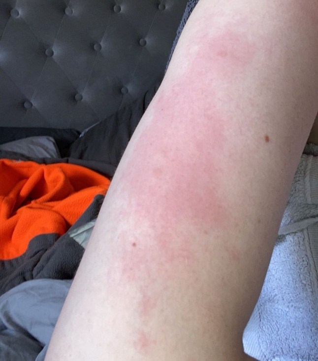 PIC FROM Kennedy News and Media (PIC SHOWS: DARCIE HAMILTON, 22, WAS LEFT WITH SORES AND RASHES DUE TO EXCESSIVE SWEATING) A woman with 'one of the worst cases' of sweating doctors have ever seen says the rare condition left her perspiring THREE LITRES of sweat a day. Darcie Hamilton, who lives near Ayr, Scotland, noticed she was sweating more than her peers at 10 years old during primary school. But as she grew older, Darcie's issue worsened, forcing her to take desperate measures to hide her problem from classmates. DISCLAIMER: While Kennedy News and Media uses its best endeavours to establish the copyright and authenticity of all pictures supplied, it accepts no liability for any damage, loss or legal action caused by the use of images supplied and the publication of images is solely at your discretion. SEE KENNEDY NEWS COPY - 0161 697 4266