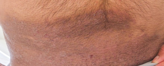 Fungal infection resistant to classical treatments, Tinea Corporis Trichophyton Indotineae