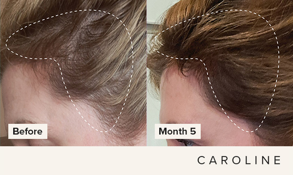 Hair growth from using Hair + Me shown in before and after shots