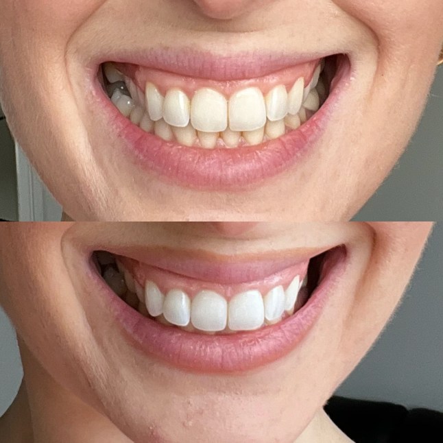Teeth before and after using the MySweetSmile whitening powder