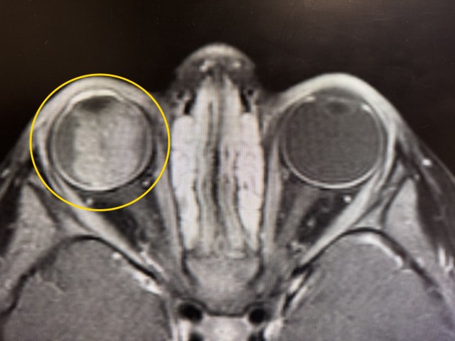 PIC FROM Kennedy News and Media (PICTURED: MILEY DRAIME, 2, HAD TUMOUR LURKING BEHIND EYE) A mum claims a baby monitor saved her tot's life after it revealed a 'glow' in her pupil - that turned out to be cancer. Kristen Draime was concerned about her daughter Miley Draime when she noticed her left eye 'wandering' in September 2025 and booked an appointment with a doctor. Initially reassured it wasn't anything to worry about, the paediatrician referred Miley for a December appointment with an ophthalmologist to rule out anything more serious. DISCLAIMER: While Kennedy News and Media uses its best endeavours to establish the copyright and authenticity of all pictures supplied, it accepts no liability for any damage, loss or legal action caused by the use of images supplied and the publication of images is solely at your discretion. SEE KENNEDY NEWS COPY - 0161 697 4266