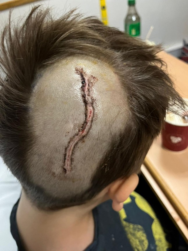 Pic from Kennedy News/ Ania Hough (Pictured:JAMIE HOUGH, NOW 10, AFTER HIS SURGERIES IN JANUARY 2024.) A mum thought her son was being 'silly' by not walking properly until discovering it was a symptom of cancer - claiming their Christmas Day walk 'saved his life'. Ania Hough, from Staplehurst in Kent, said her then eight-year-old son Jamie Hough had first complained of a headache in October 2023 and started vomiting. Initially, the mum-of-two thought he had picked up a school sickness bug but after calling 111 she took him to A&E at Maidstone Hospital in Kent. DISCLAIMER: While Kennedy News and Media uses its best endeavours to establish the copyright and authenticity of all pictures supplied, it accepts no liability for any damage, loss or legal action caused by the use of images supplied and the publication of images is solely at your discretion. SEE KENNEDY NEWS COPY - 0161 697 4266