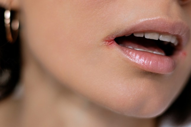 Close up of woman having problem with mouth disease, dry skin on corner of chapped lips with visible irritation or angular cheilitis, cracks, visible irritation in the corners of the mouth, redness