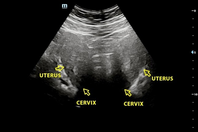 An ultrasound scan of Ellie Curran's two wombs - Ellie Curran who had to go to the toilet "every two seconds" while on her period discovered it's because her womb is split in half. // The medical condition ? called complete bicorporeal uterus ? occurs where the uterus has a deep external indentation at the top which creates two distinct heart-shaped uterine cavities that are fully separated by a wall of tissue. Ellie Curran, 21, first started experiencing intense pain when she started her period aged 12. Alongside ?leaking? through sanitary products she has found herself unable to ?leave the house? due to the intensity of the pain ? and received a diagnosis of PMDD ? Premenstrual Dysphoric Disorder ? in November 2025. Doctors removed her appendix when she was 19 due to her stomach pain but found it had not ruptured. During the surgery they found what they believed to be an extra womb and Ellie was referred to a women?s clinic. After further scans doctors ?didn?t know for sure? whether Ellie?s uterus was completely split into two ? Uterus Didelphys ? or was one uterus that had an indentation, called a Bicoporeal Uterus. Photo released 23/01/2026